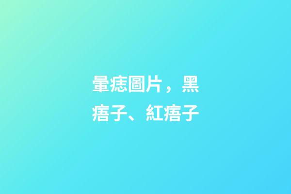 暈痣圖片，黑痦子、紅痦子-第1張-觀點-玄機派